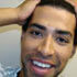receding hairline