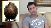 cure for baldness