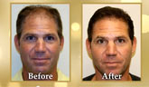 follicular units