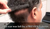 hair restoration