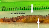 hair  grafts
