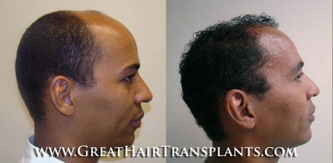 hair transplant surgery