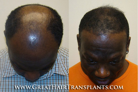 hair transplant surgery