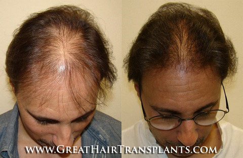 hair transplant doctors