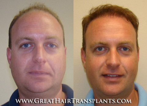 hair transplant cost