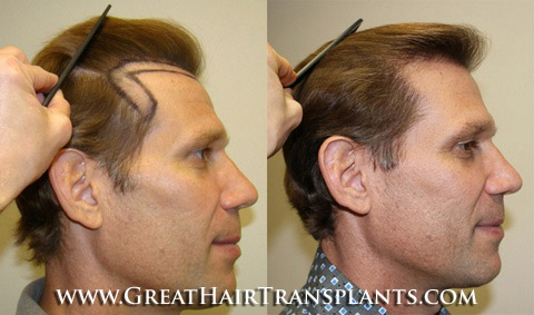 hair transplantation