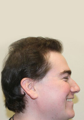 hair transplant before after Photos