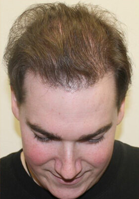 hair transplant before after Photos