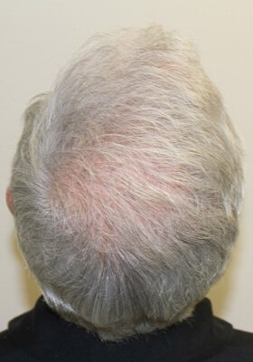 hair transplant before after Photos