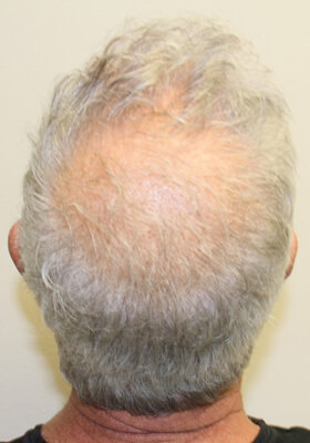 hair transplant before after Photos