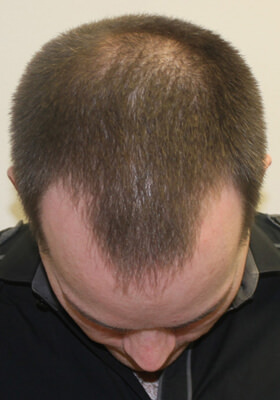 hair transplant before after Photos