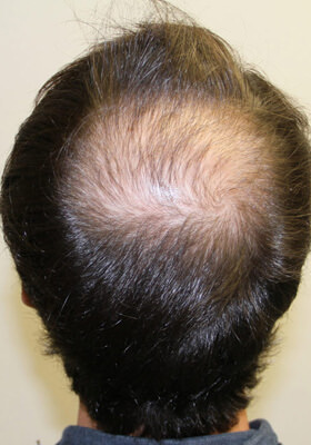 hair transplant before after Photos