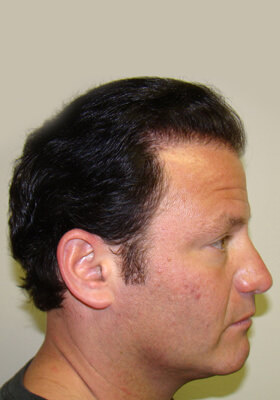 hair transplant before after Photos