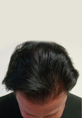 hair transplant before after Photos