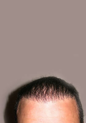 hair transplant before after Photos