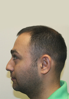 hair transplant before after Photos