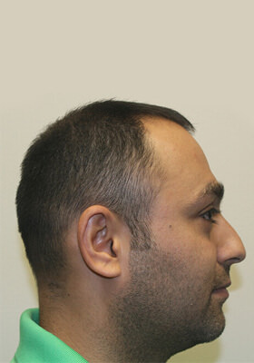 hair transplant before after Photos