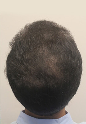 hair transplant before after Photos