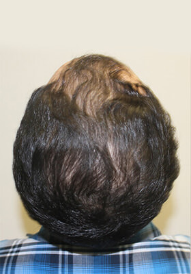 hair transplant before after Photos