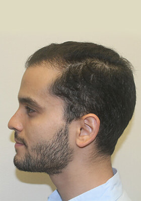 hair transplant before after Photos