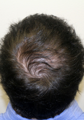 hair transplant before after Photos