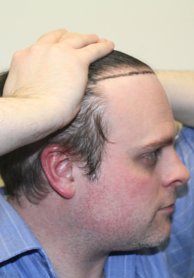 hair transplant before after Photos