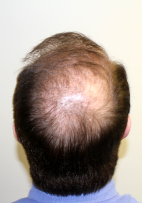 hair transplant before after Photos