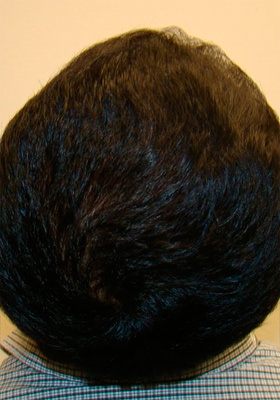 hair transplant before after Photos