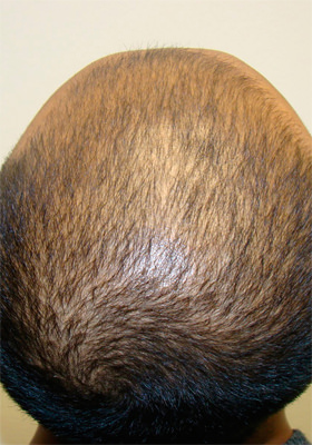 hair transplant before after Photos