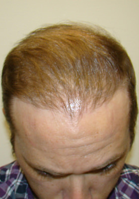 hair transplant before after Photos