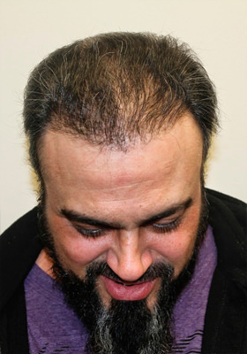 hair transplant before after Photos