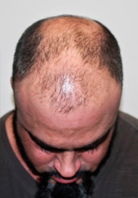 hair transplant before after Photos