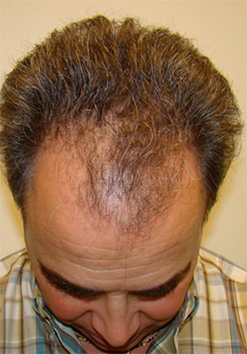 hair transplant before after Photos