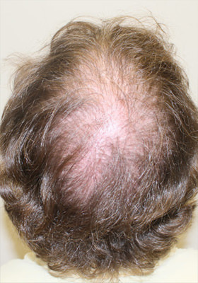 hair transplant before after Photos