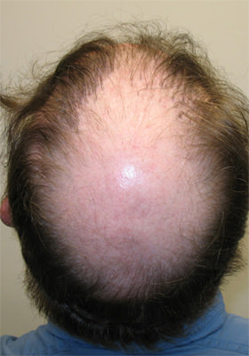 hair transplant before after Photos