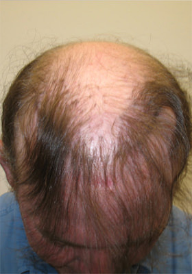 hair transplant before after Photos