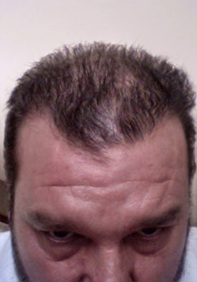 hair transplant before after Photos