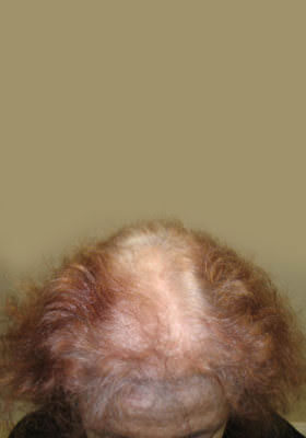 hair transplant before after Photos