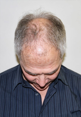 hair transplant before after Photos