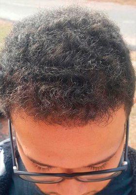 hair transplant before after Photos