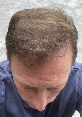 hair transplant before after Photos