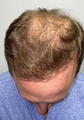 hair transplant before after Photos