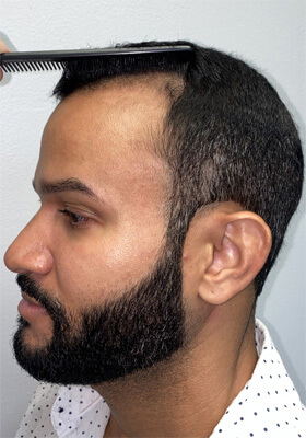 hair transplant before after Photos