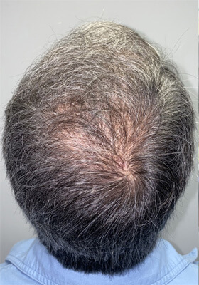 hair transplant before after Photos