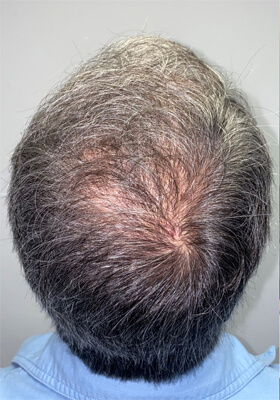 hair transplant before after Photos