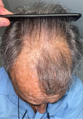 hair transplant before after Photos