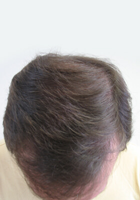 hair transplant before after Photos