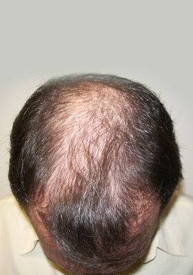 hair transplant before after Photos