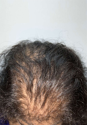 hair transplant before after Photos