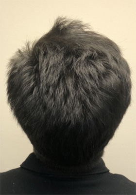 hair transplant before after Photos